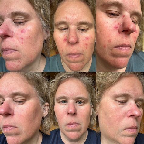 Progress with Metronidazole Cream : r/Rosacea