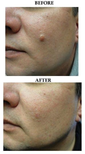 Before & After Skin Tag and Mole Removal Photos - The Medical Spa