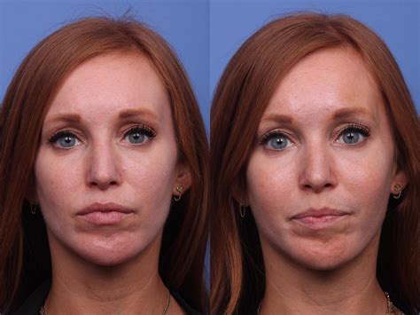 Cheek Implant Before and After Photo Gallery | Scottsdale, AZ | Hobgood Facial Plastic Surgery ...