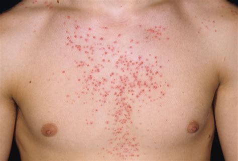 STEROID INDUCED ACNE – Dermatology Conditions and Treatments