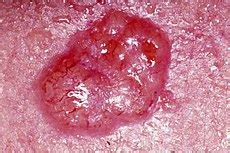 Skin cancer - Wikipedia, the free encyclopedia