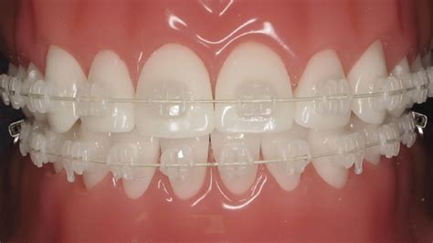 Clear Ceramic Braces In Fort Collins For Adults Use - bitbitbyte