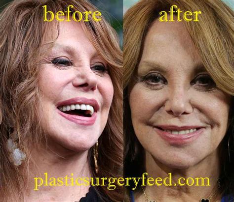 Marlo Thomas Plastic Surgery - Plastic Surgery Feed