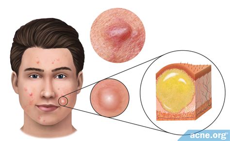 What Is an Acne Cyst? - Acne.org