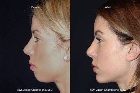 Chin Implant | Beverly Hills Plastic Surgeon - Dr. Jason Champagne