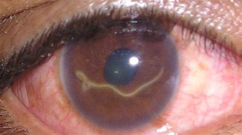 WTF! Mujer con una lombriz dentro de su ojo - Off-topic - Taringa!