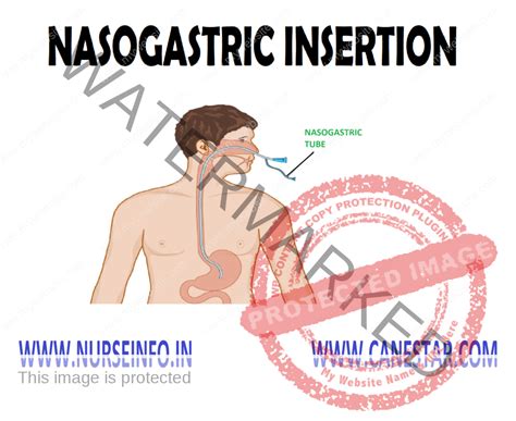 NASOGASTRIC INSERTION - Nurse Info