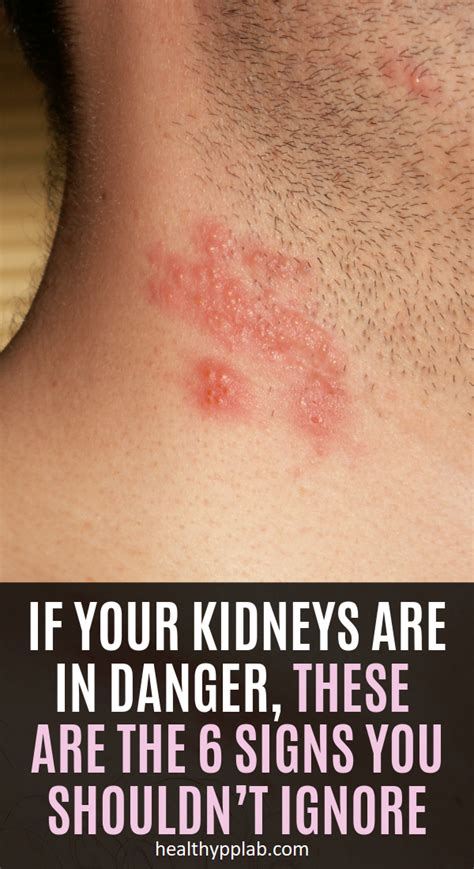 If Your Kidneys Are In Danger, These Are The 6 Signs You Shouldn’t ...