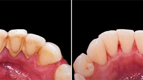 Deep Teeth Cleaning: Before and After - Dental Health Society