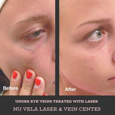 How To Get Rid Of Veins Under Eyes - ScienceHUB