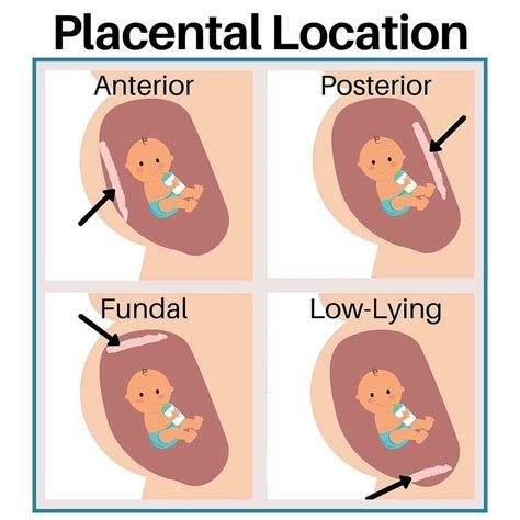 Placenta location | Midwifery student, Mother baby nursing school, Midwifery