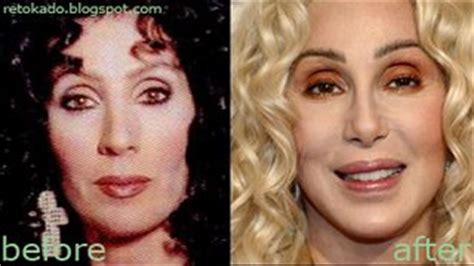 Cher's Plastic Surgery - Filipino Celebrity Plastic Surgery: Retoke