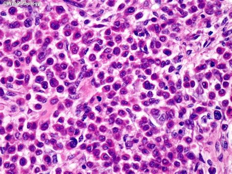 Webpathology.com: A Collection of Surgical Pathology Images