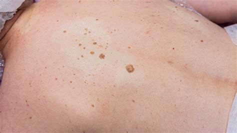 Can Age Spots Be Raised? Exploring The Truth Behind Skin Bumps