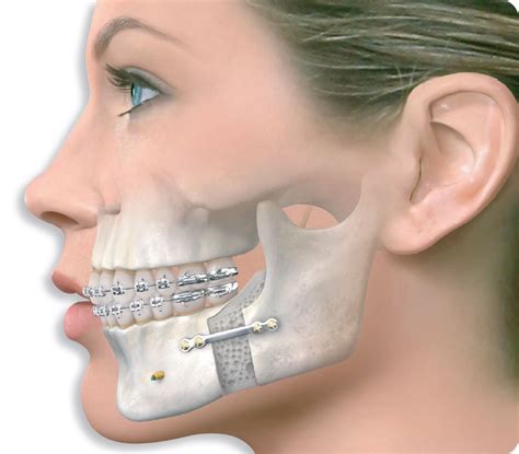 Jaw Surgery for Orthodontics (Maxilla and Mandible) - Kids Dental Online - Plano & Carrollton