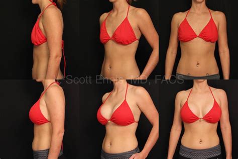 Before And After Plastic Surgery Breast Augmentation