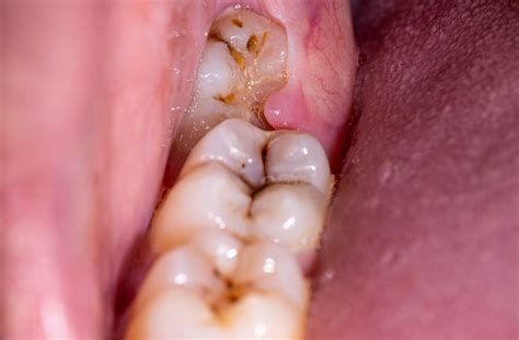 Can a Wisdom Tooth Cause an Abscess? | Marks Dentistry