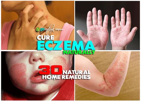 30 Natural Home Remedies for Eczema (Atopic dermatitis) in Kids & Adults - Part 2 - Natural Home ...