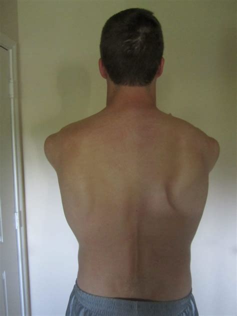 Scapular Dyskinesia: an often neglected cause of Neck Pain | Active Physiotherapy Solutions ...