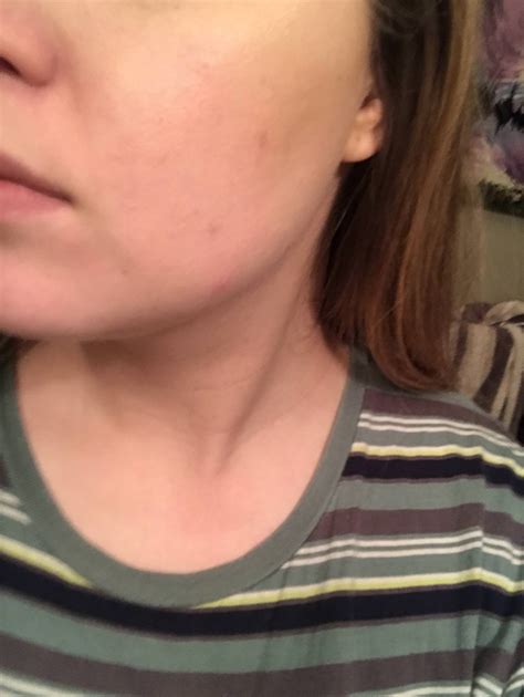 [acne] Cysts on chin and jawline. Advice please! : SkincareAddiction