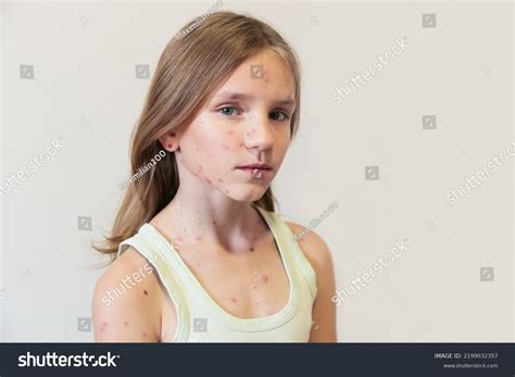 Cute Little Girl Chickenpox Home Varicella Stock Photo 2199032357 ...