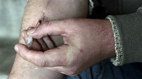 Krokodil hype: Is toxic 'flesh-eating' street drug in Canada? - Health ...