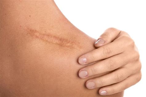 Scar Prevention and the Stages of Wound Healing