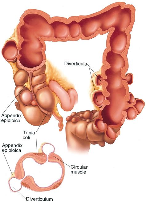 Diverticulitis — Suncoast Surgical Associates