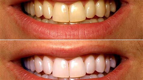 Teeth Whitening Dentist Before After - White Choices
