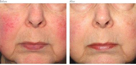 IPL Facial Wilmington, NC | Laser Skin Resurfacing Near Me ...