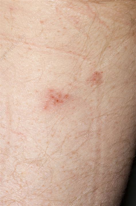 Shingles rash - Stock Image - M260/0373 - Science Photo Library
