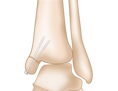 Ankle Fractures (Broken Ankle) - OrthoInfo - AAOS