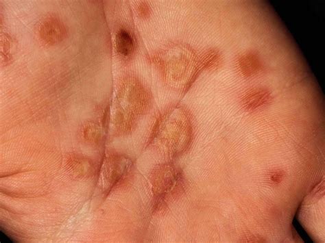 Toxic Epidermal Necrolysis: Causes, Symptoms, Treatment