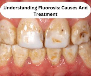 Understanding Fluorosis: Causes And Treatment | The Team Dental