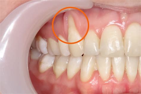 Understanding Gum Recession: Causes, Symptoms, and Treatment