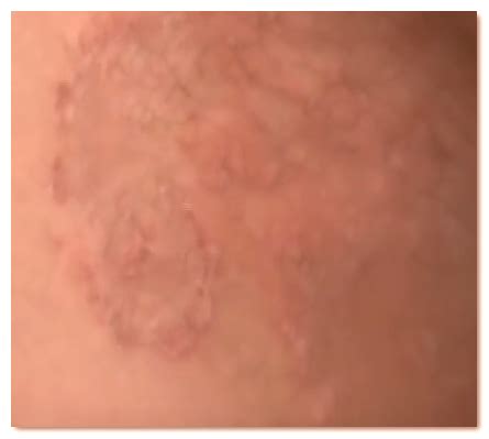 Intertrigo - Rash Pictures, Symptoms, Causes, treatment