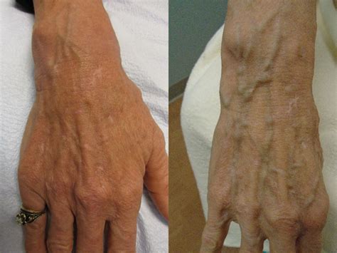 When and Why Do Hand Veins Become More Obvious? - Denver Vein Center