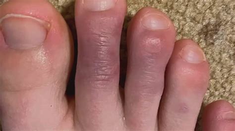 What are COVID toes? - YouTube