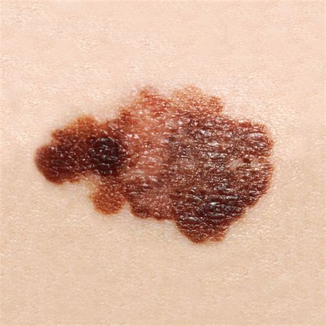 New exciting advance in Melanoma Treatment | Lakeview Dermatology Chicago