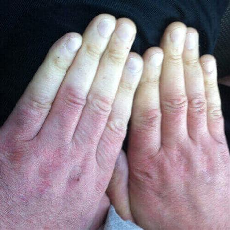 Hand-Arm Vibration Syndrome (HAVS) - KML Occupational Health