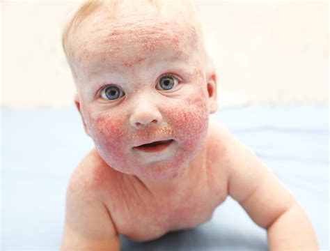 Treating newborn facial rash – Telegraph