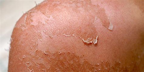 5 Ways to Safely Treat Peeling Skin From a Sunburn