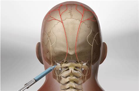 Occipital Nerve Block - Florida Surgery Consultants