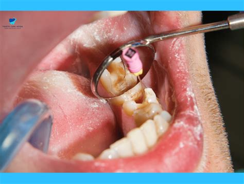 What is Hypocalcification Teeth | All You Need to Know