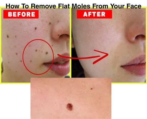 How To Remove Flat Moles From Face At Home Naturally