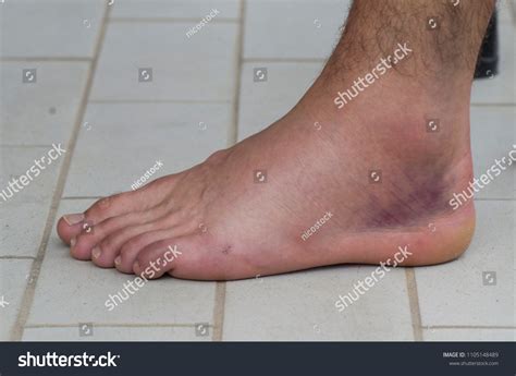 Ankle Sprain Injury Stock Photo 1105148489 | Shutterstock