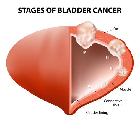 Urologic Cancer: Types, Symptoms, Stages, Diagnosis & Treatments