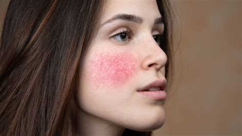 Rosacea Explained: Causes, Symptoms, And Treatments