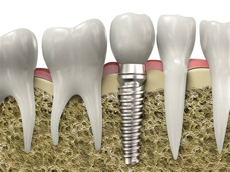 Obstructive Sleep Apnea Causes Complications in Dental Implants | Sleep Review