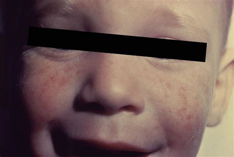 Meningitis Viral Rash Baby / Rashes In Babies And Children Nhs - just ...